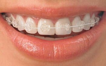 braces