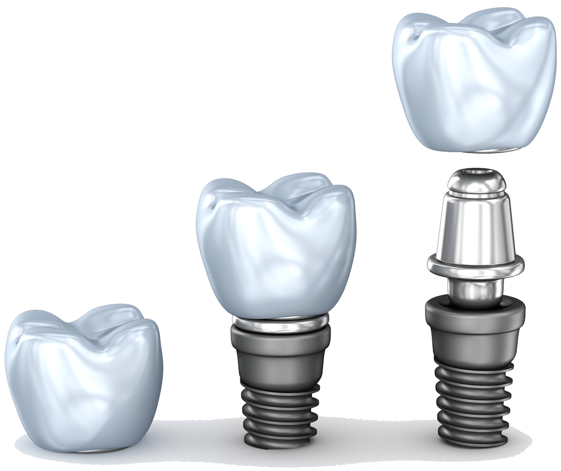 Dental Implant