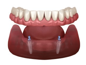 Dental Implants