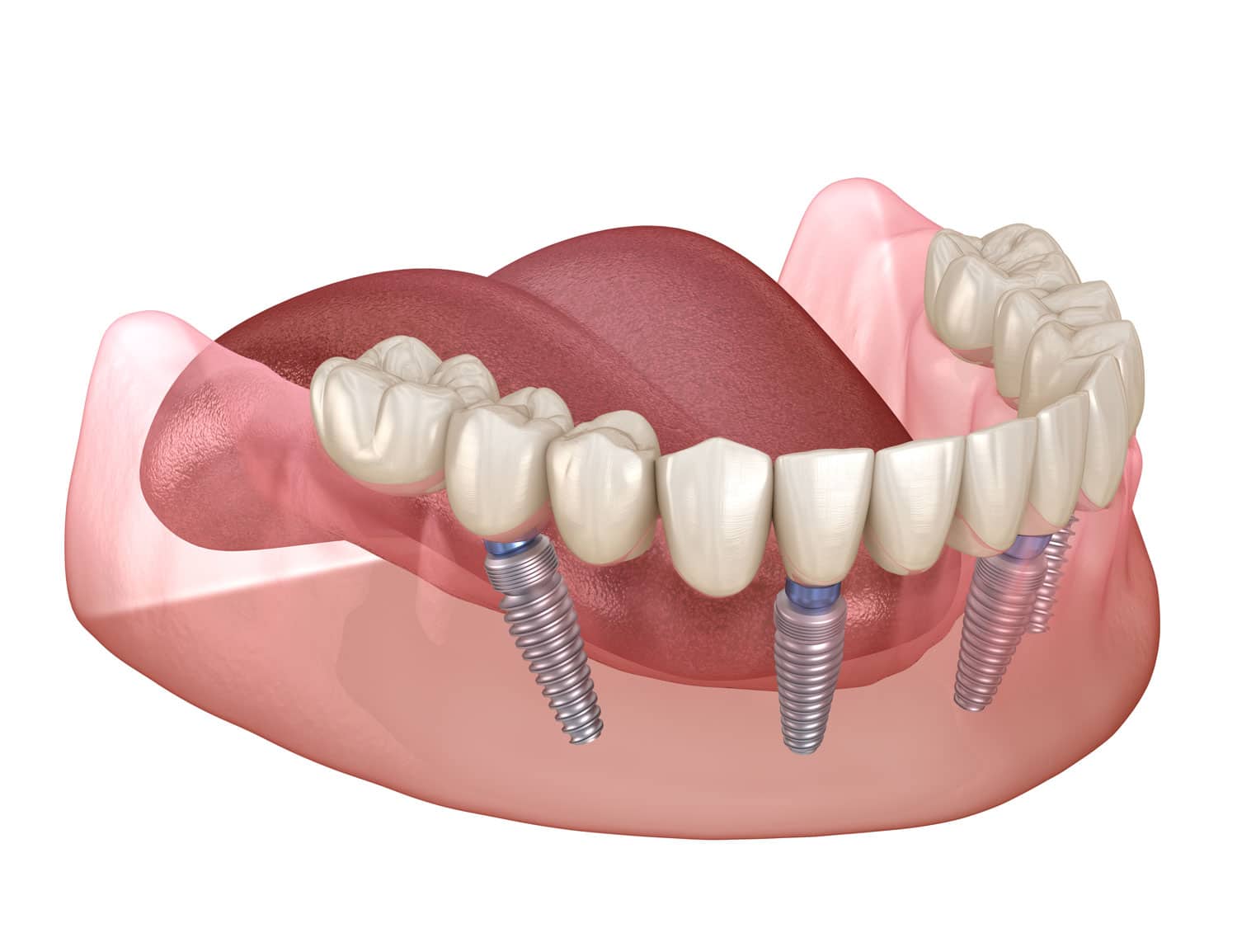 Dental Implants