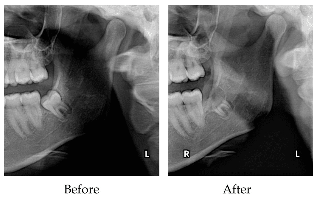 Tooth Extraction