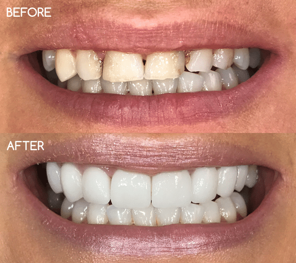 Dental Veneer