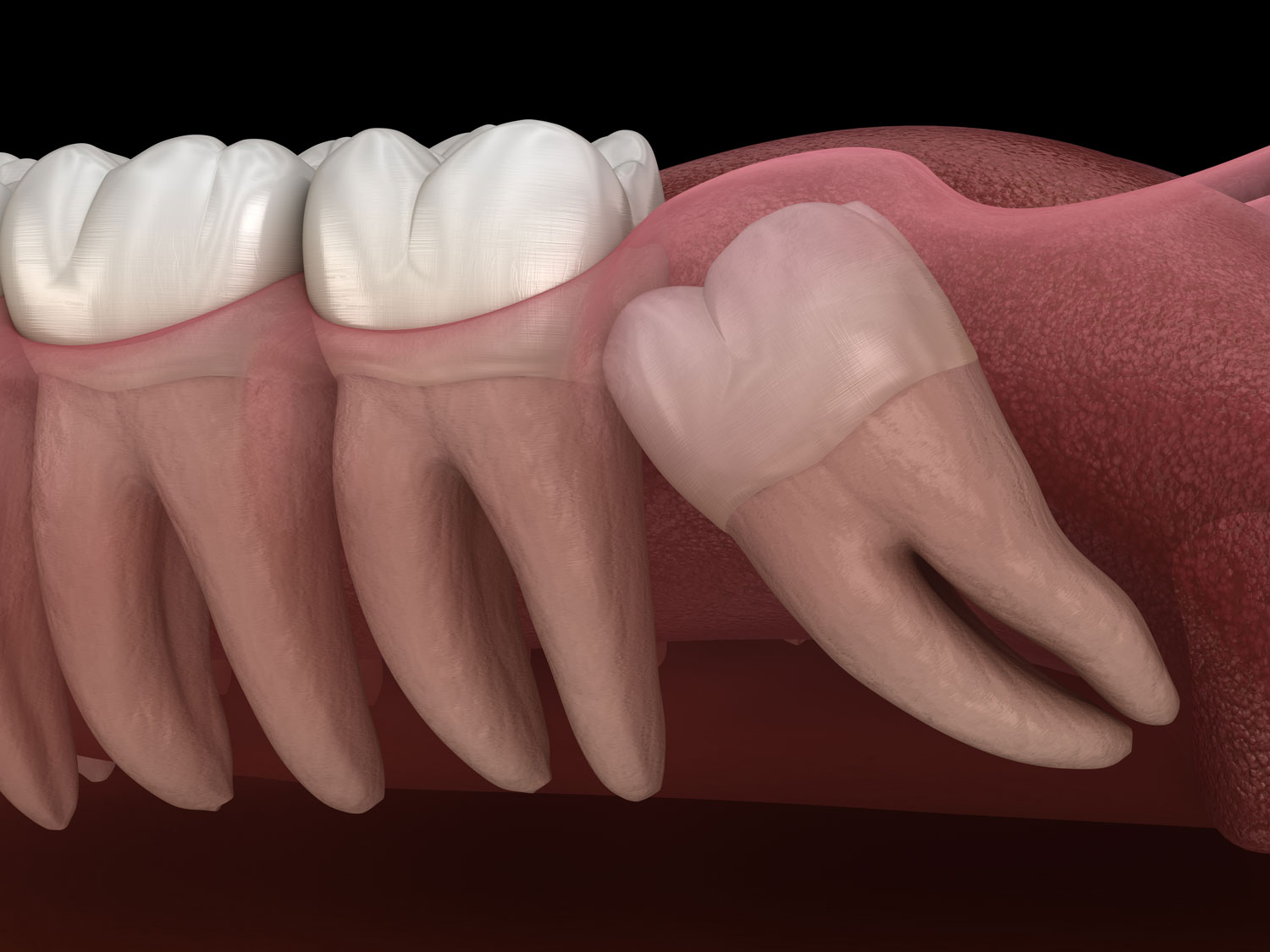 Wisdom Tooth Extraction