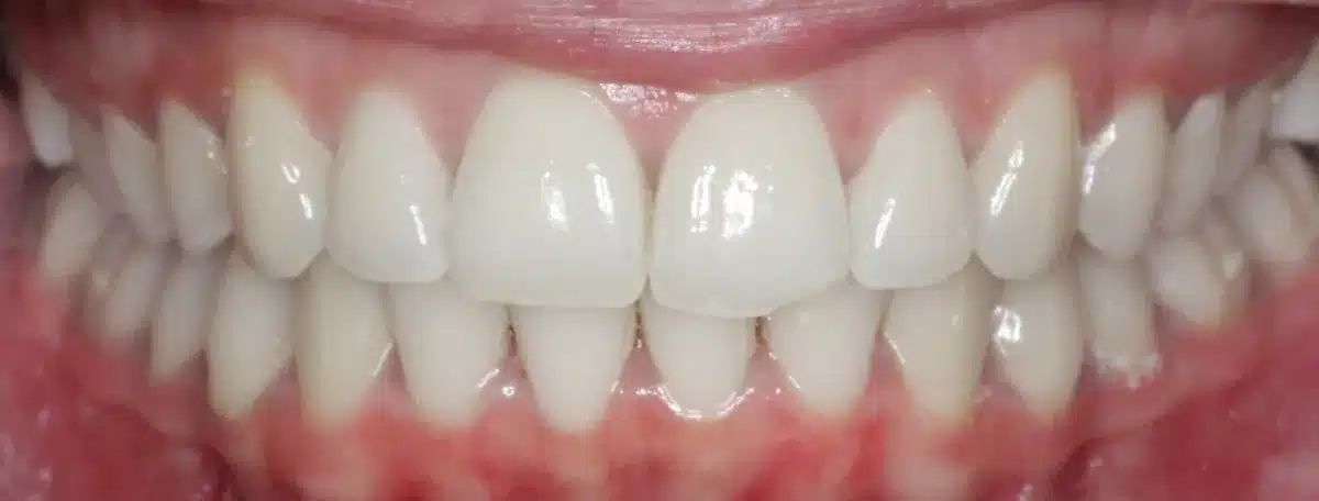 Overbite — after