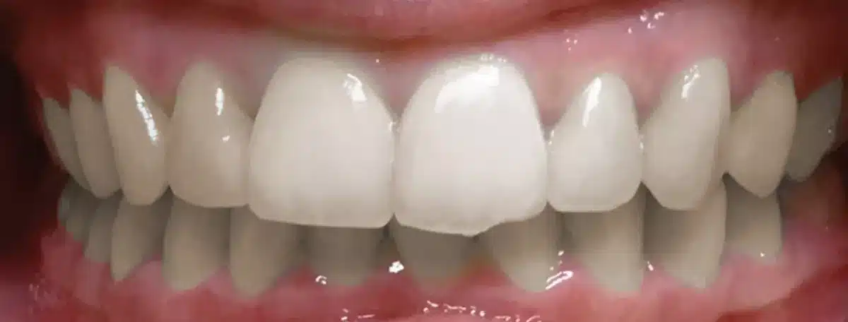 Overbite — before