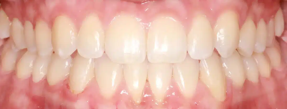 Underbite — after