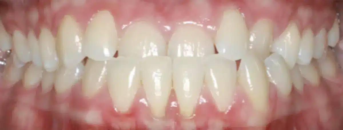 Underbite — before